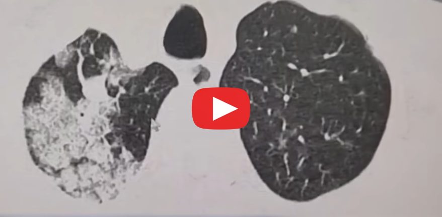 150 millions de nodules pulmonaires en Chine simple dépistage ou bombe sanitaire cachée